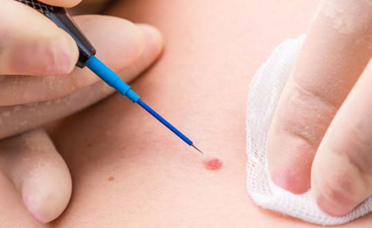 HPV