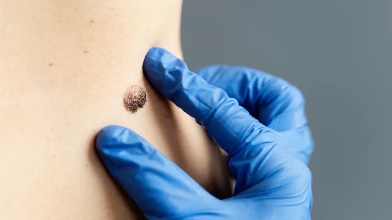 Genital Siğiller HPV (Kondilom)
