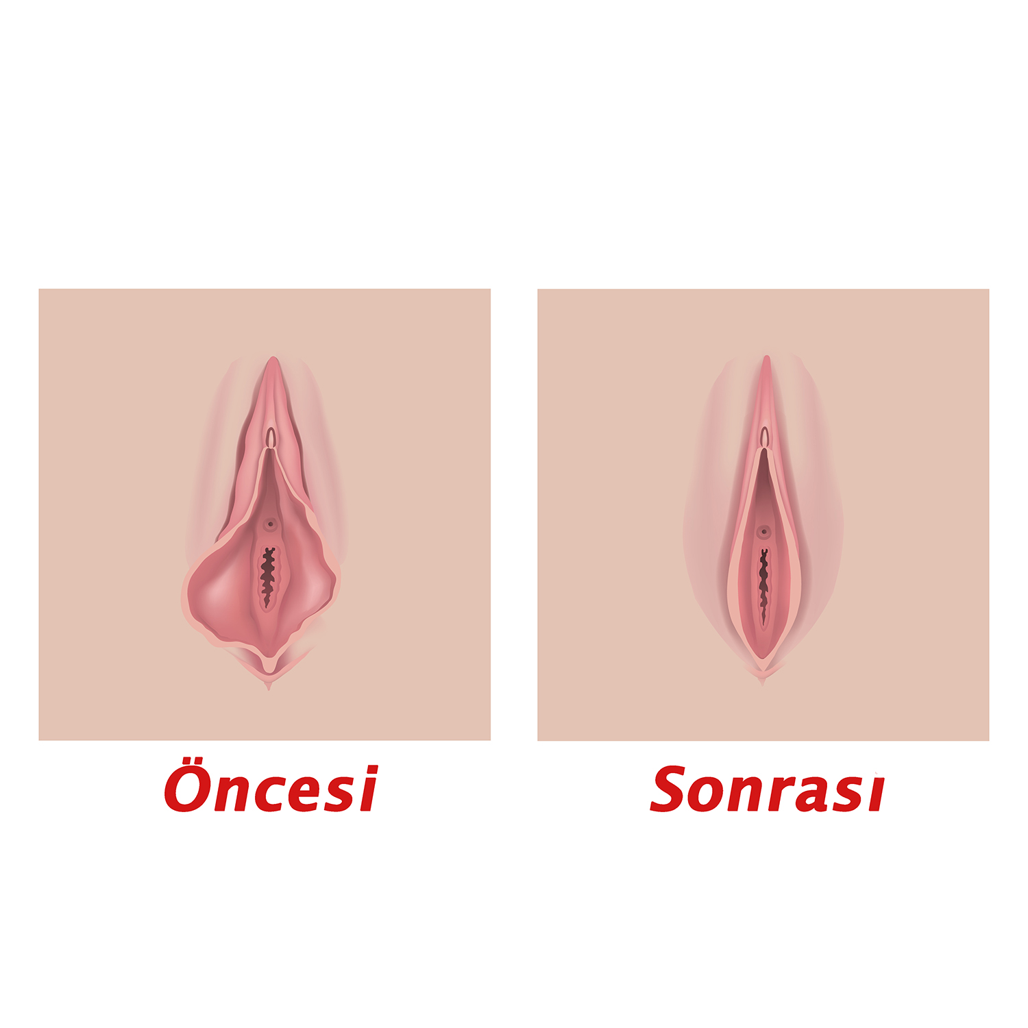 Labioplasti